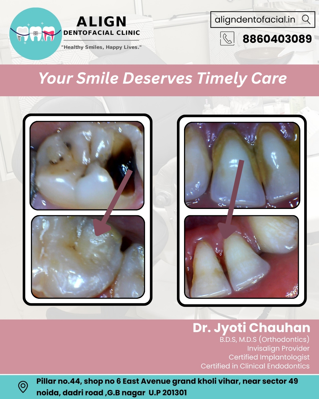 Tooth Decay & Enamel Repair (Before & After)
