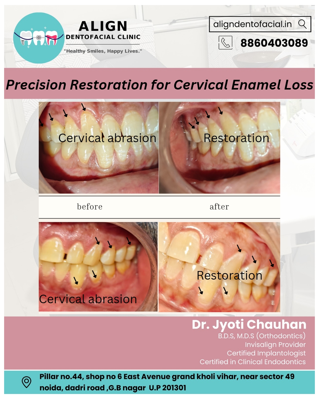 Cervical Abrasion Enamel Restoration